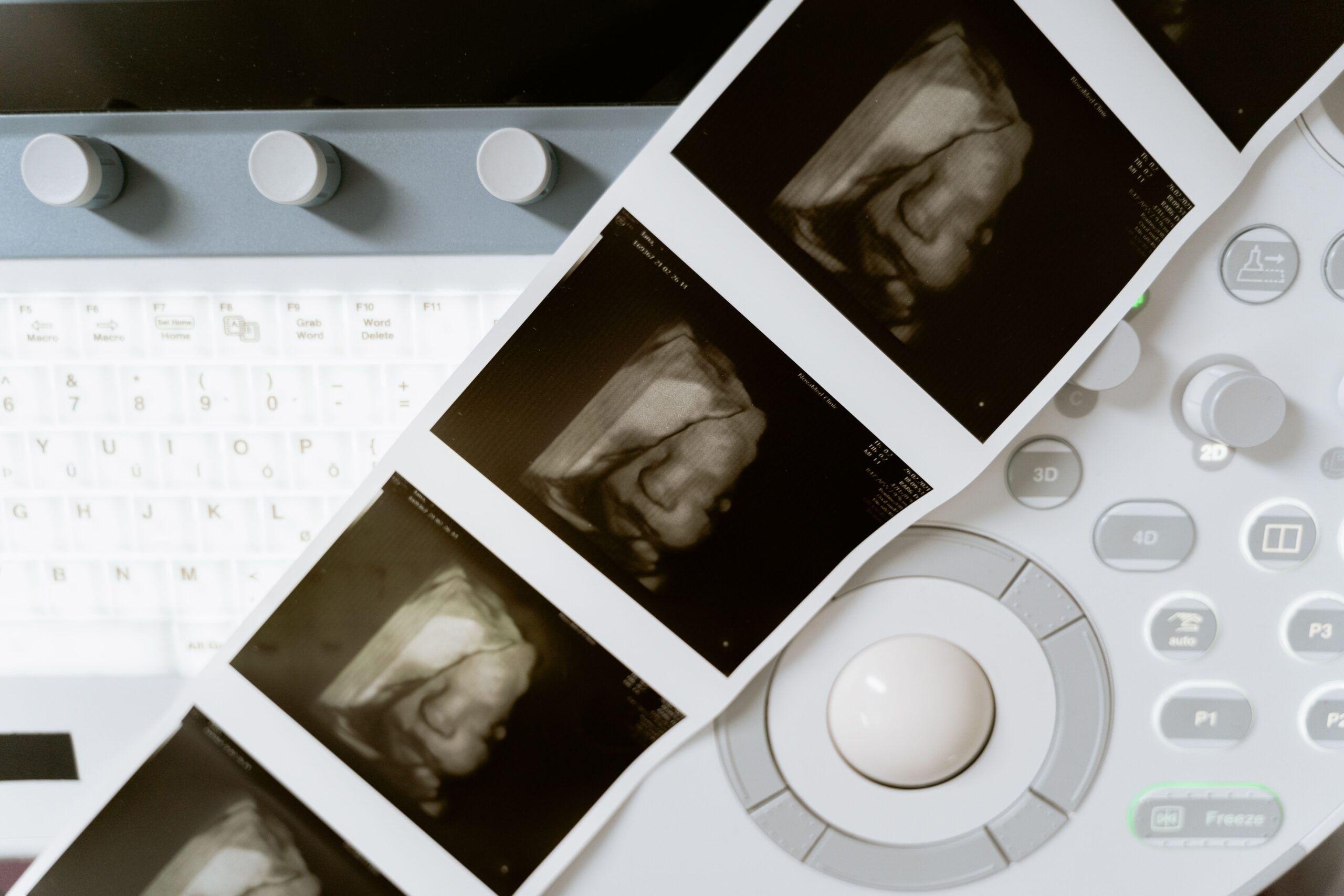 Ultrasound printouts laid across an ultrasound machine with control knobs and a keyboard visible in the background
